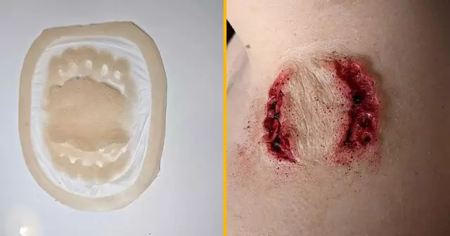 prothese-forme-morsure