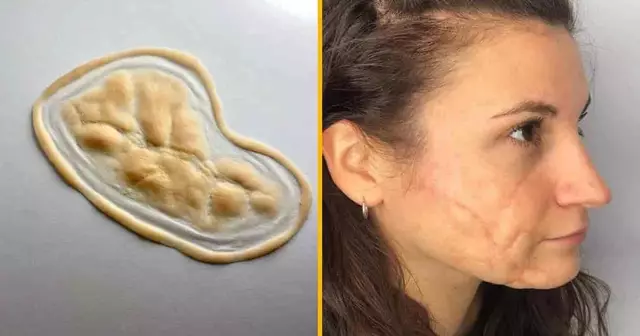 prothese-ouverture-thorax